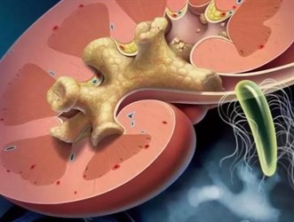 Большой коралловидный камень левой почки у молодого пациента